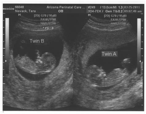 We’re pregnant with twins! – Wes Novack