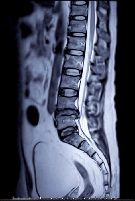 Spine MRI Results and Medical Decision Making: Get All Your Options