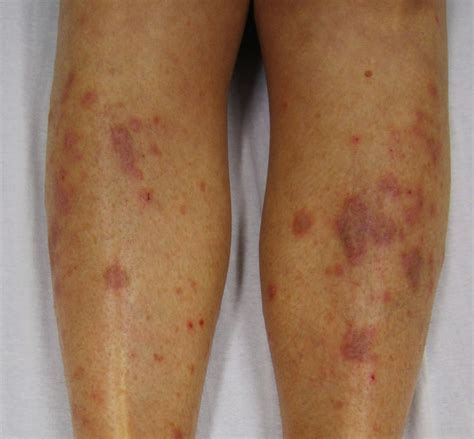 The Causes And Treatment Of Lichen Planus | Health And Beauty