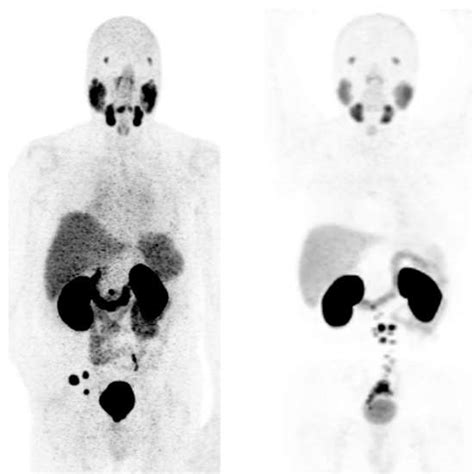 PSMA PET Scan, Preparation, Procedure, and the Requirements