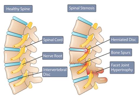 Lumbar Spinal Stenosis | Columbia Orthopaedic Group