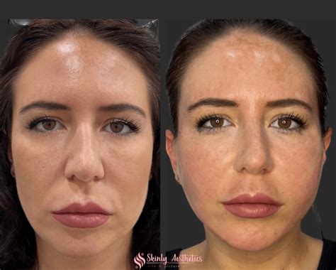 PDO Thread Lifting - Before and After Results at Skinly Aesthetics