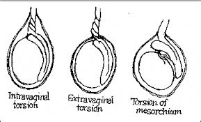 Paediatric Emergency Medicine: Testicular Torsion