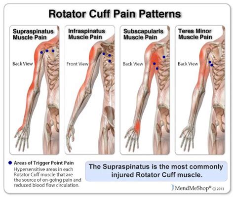 Moreland Osteopathy - Shoulder Pain conditions treated