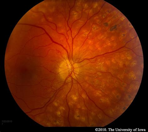 Diabetic Retinopathy for Medical Students. EyeRounds.org ...