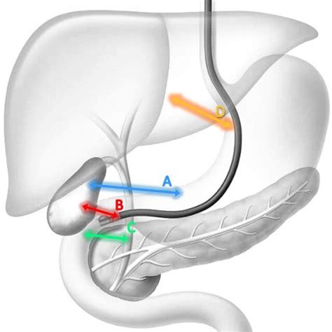 This figure describes the EUS-guided drainage techniques: (A ...