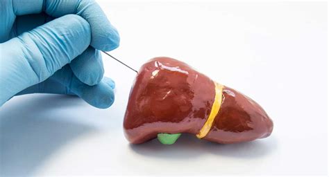 Liver Biopsy | Liver Doctor