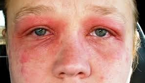 Eyelid eczema – Allergy Best Buys