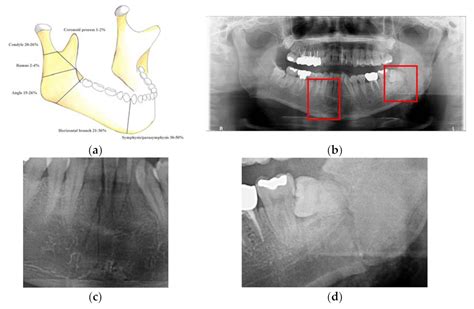 Mandibular Fracture Classification