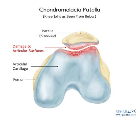 Chondromalacia Patella | Rehab My Patient