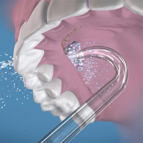 Snapklik.com : Waterpik Genuine Implant Denture Replacement Tips, Water ...