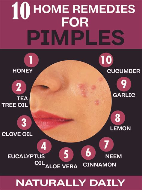 16 Natural Home Remedies for Pimples (Evidence-Based) | Home remedies ...