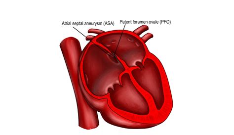 Patent Foramen Ovale Symptoms and Treatment | Dr. C Raghu