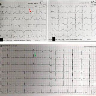 Electrocardiograph (ECG). ECG at admission shows sinus rhythm and QTc ...