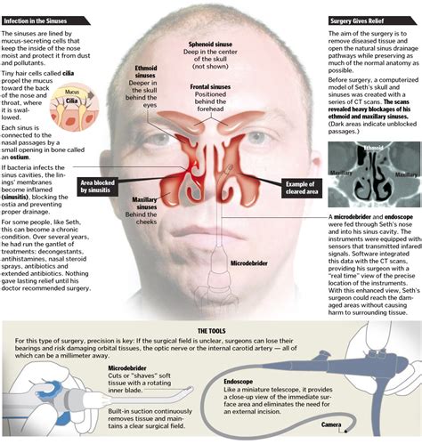 A Better Tomorrow: Image guided sinus surgery