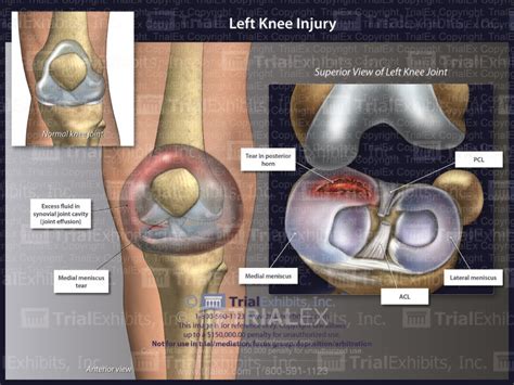 Left knee Injury - Trial Exhibits Inc.