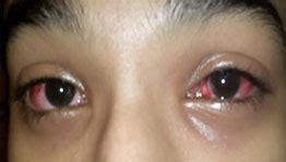 Dealing With Sore Eyes (Viral Conjunctivitis) - Utsav Eye Clinic