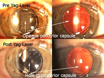 Laser Surgery: Yag Eye Yag Laser Surgery Side Effects