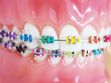 How to Select the Right Braces Colors - Orthodontic Arts