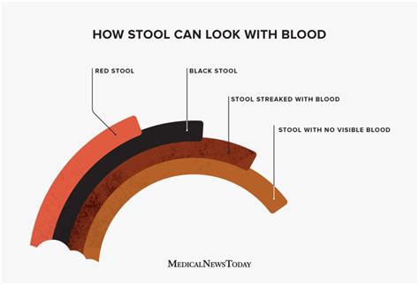 Bright red blood in stool diverticulitis: Diverticular Bleeding | Cigna