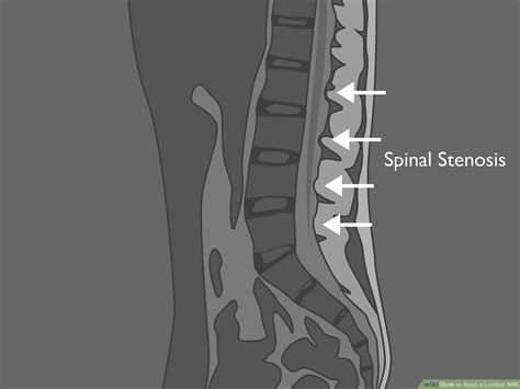 Normal Vs Abnormal Mri Lumbar Spine