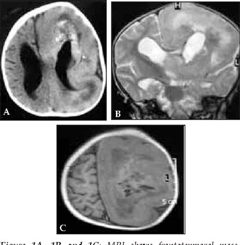 Figure 1 from The treatment of cerebral salt wasting with ...