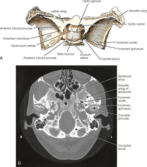 Greater And Lesser Wing Of Sphenoid Ct - slidesharetrick