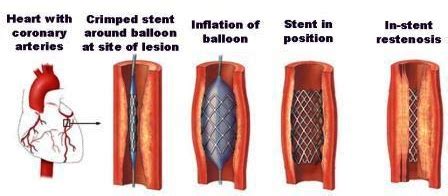 In-stent restenosis - mapper-project.eu