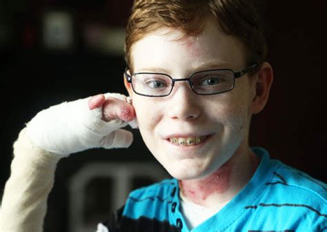 Butterfly Boy Jonathan Pitre's skin falls off with the slightest touch