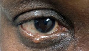 Derm Dx: A translucent 'bump' on the lower eyelid - Clinical Advisor