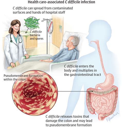 C Difficile - Resume Themplate Ideas