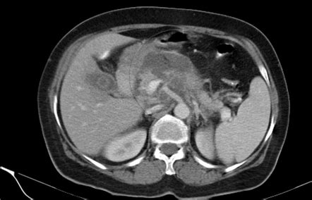 Hemorrhagic Pancreatitis Ultrasound