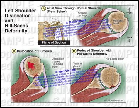 Left Shoulder Dislocation and Hill-Sachs Deformity - Medivisuals Inc.