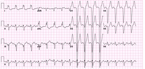 Left bundle branch block electrocardiogram - wikidoc