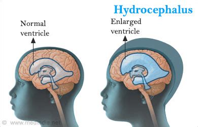 Hydrocephalus - Types, Causes, Symptoms, Diagnosis, Treatment, Health Tips