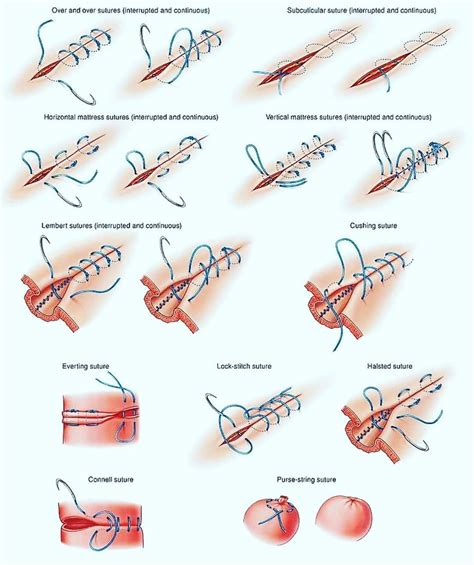 Medical Mnemonics’s Instagram photo: “Different type of surgical ...