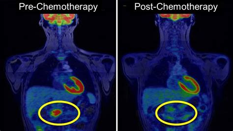 PET/MRI biomarkers guide personalized treatment for patients with ...