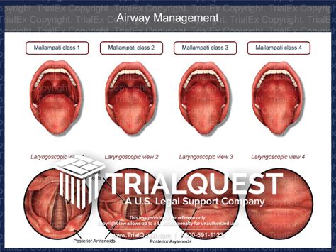 Airway Management - TrialQuest Inc.