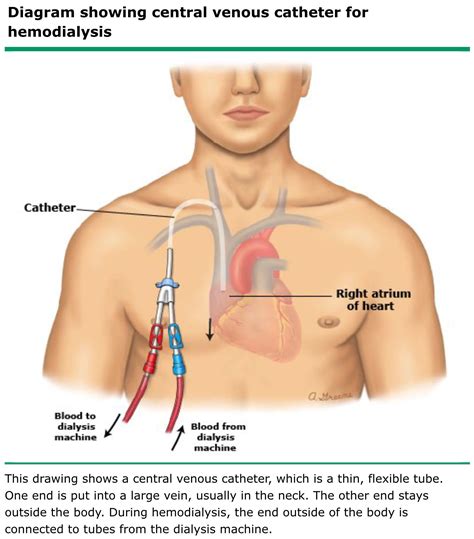 Central Venous Catheter (HD) | Central venous catheter, Catheter ...