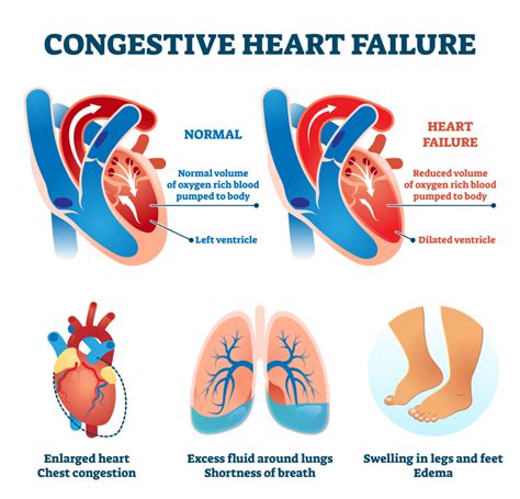 Chronic Systolic Heart Failure: An Ailment of All Times