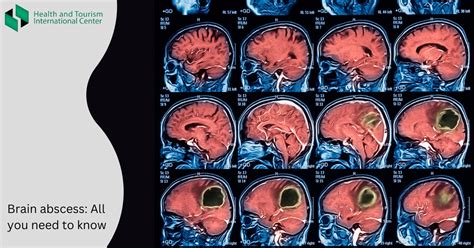 Brain abscess - methods of diagnosis and treatment - HTI CENTERS ...