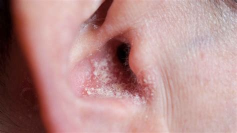 Psoriasis In The Ear: Symptoms, Treatment, and Prevention – Dermeleve®