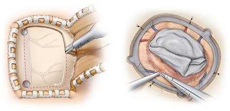 Meningioma Surgery | Expert Surgeon | Aaron Cohen-Gadol, MD