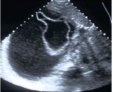 Ultrasonography of Hydatid cyst of the liver type II ( Gharbi) | Cysts ...