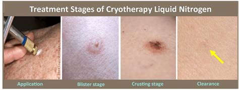 Cryosurgery – Dermatology Matters