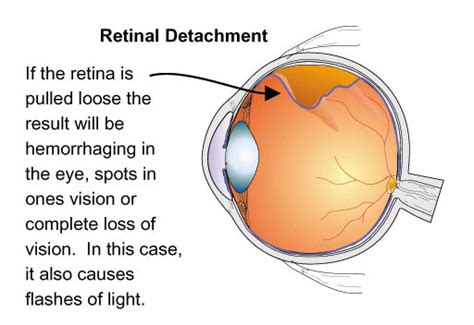 Retinal Detachment: The Signs, Symptoms, and Solutions | Ocular ...