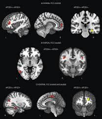 Posterior Cortical Atrophy