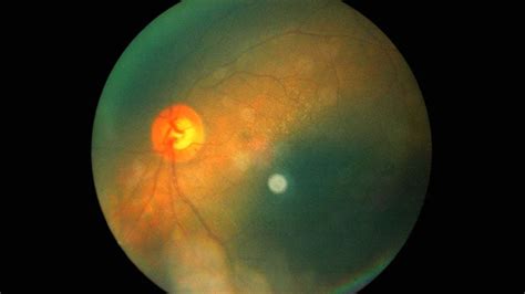 AMD and Retinal Disease | Medscape