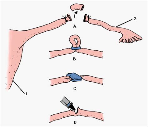 - Female Sterilization Reversals