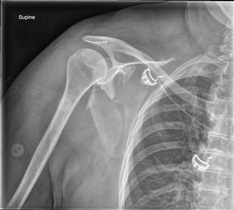 Comminuted Scapular Fracture